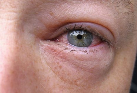 Itchy Dry Skin Around Eyes - Health and Wellness Digest