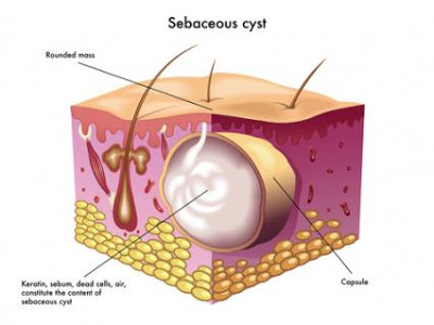 the cyst forming species of heterodera