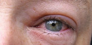 Palpebra superiore e inferiore gonfia
