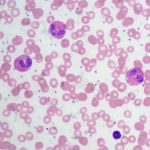 Eosinofili bassi cause