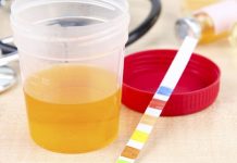 Proteinuria alta