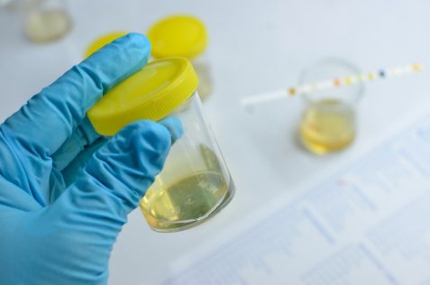 Urobilinogeno alto urine