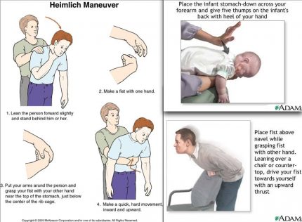 Manovra Heimlich