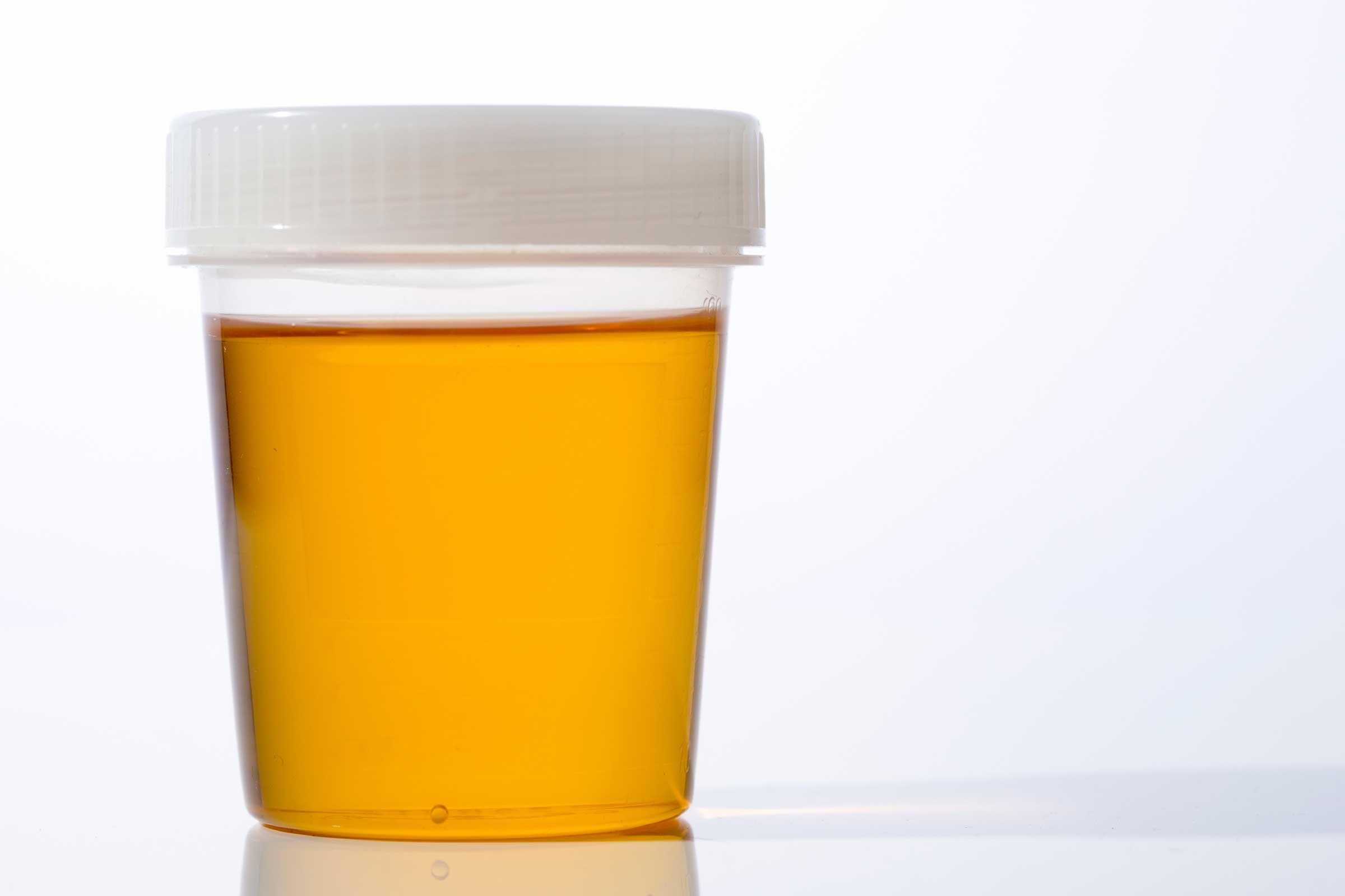 proteine nella perdita di peso delle urine