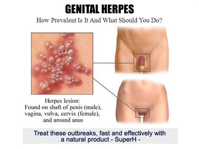 Herpes genitale