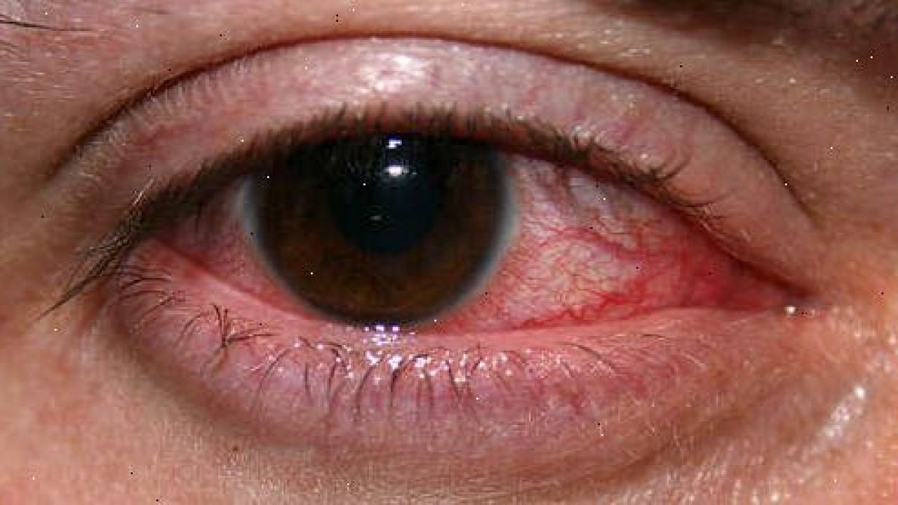 lherpes può portare alla prostatite lherpes può portare alla prostatite