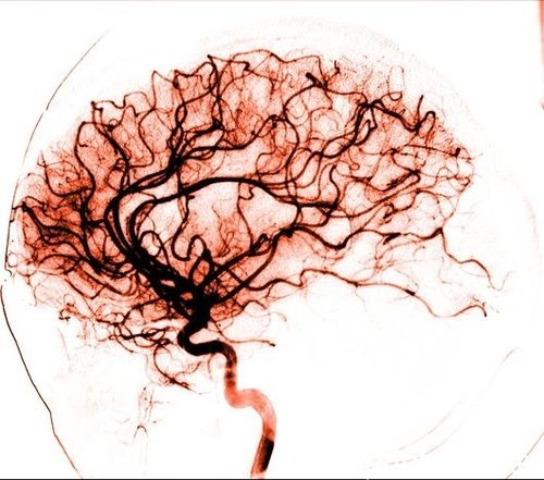 Angiografia cerebrale