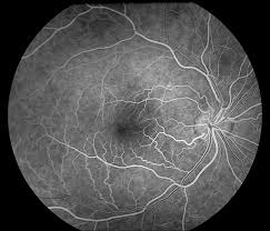 angiografia oculare