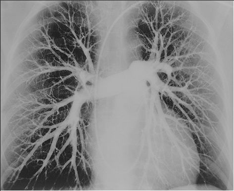 angiografia polmonare