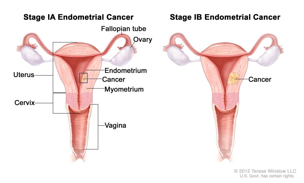 Biopsia endometrio