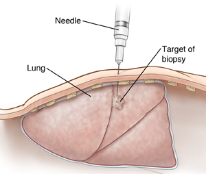 Biopsia polmonare