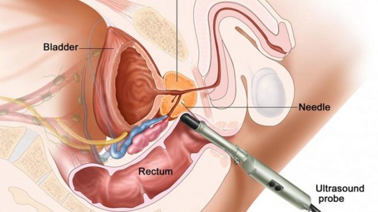 quanto è dolorosa una procedura di biopsia prostatica