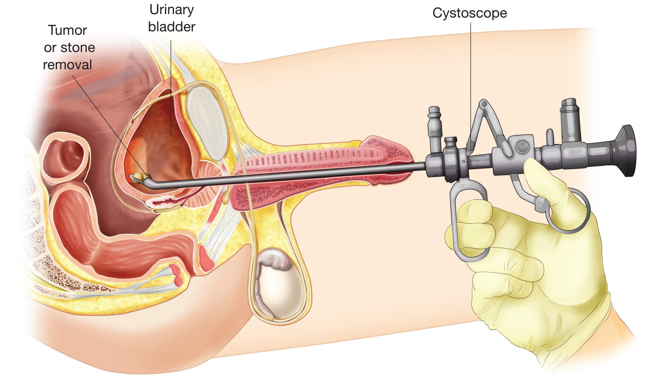 cistoscopia ingrossamento della prostata