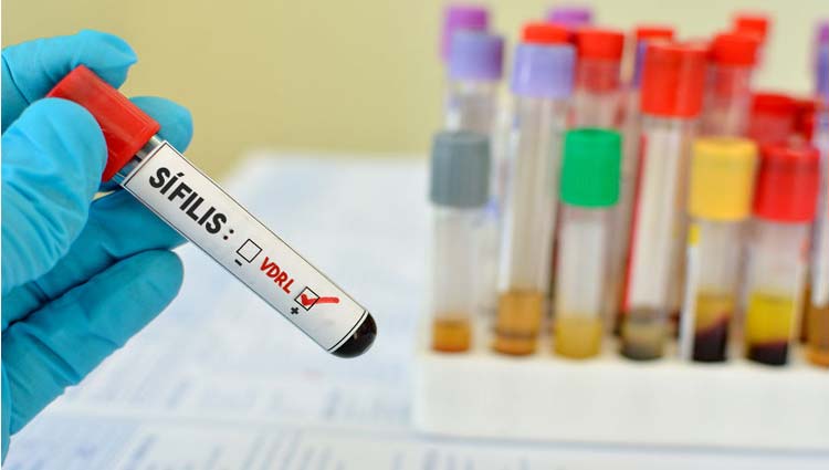hospital dish Living room VDRL: Leggi la Guida Completa sul Test per la Diagnosi di Sifilide!