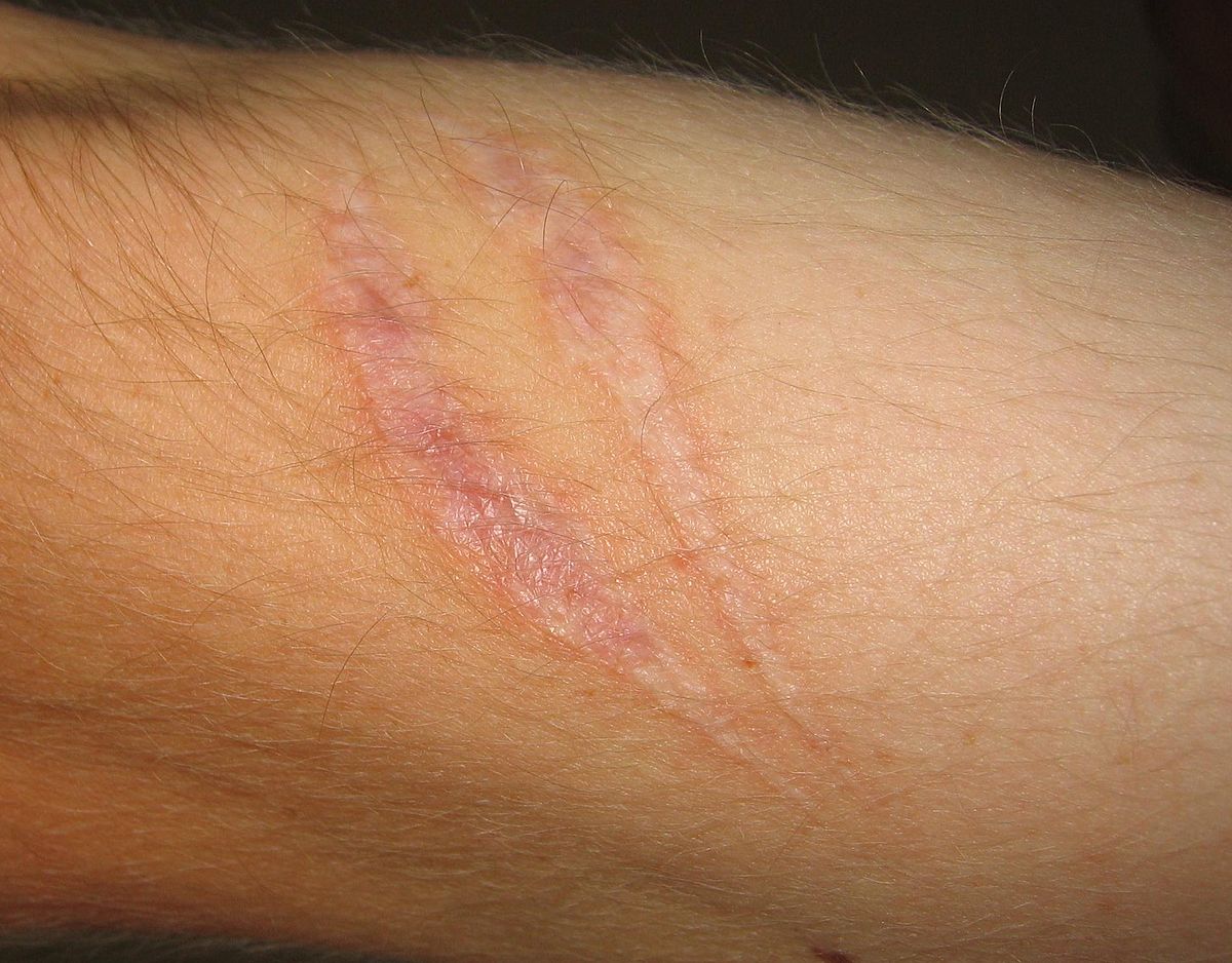 trattamento per cicatrici