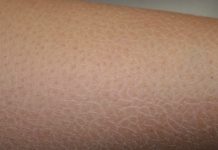 xerosi cutanea cause