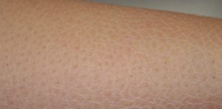 xerosi cutanea cause
