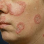 lupus eritematoso discoide cause