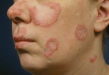 lupus eritematoso discoide cause