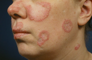 lupus eritematoso sistemico