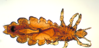 Pidocchi: come riconoscere, curare e prevenire la pediculosi