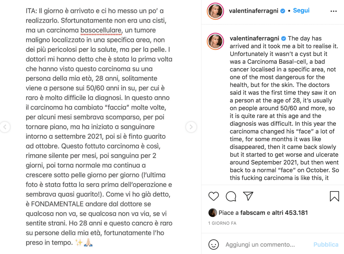 Valentina Ferragni Carcinoma Basocellulare