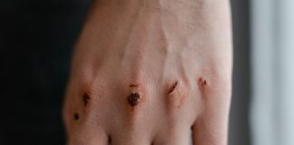 Sindrome di Morgellons: cause e rimedi per questo disturbo misterioso