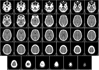 Ematoma cerebrale conseguenze