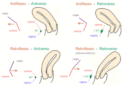 Utero antiverso, retroflesso, retroverso